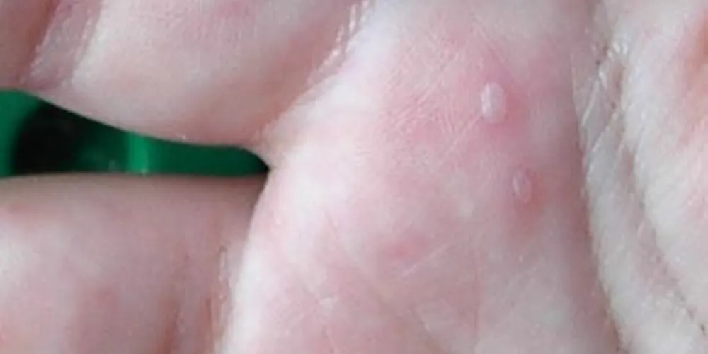 Enfermedad mano-pie-boca