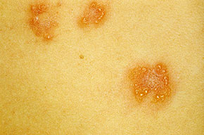 Dermatitis Herpetiformis