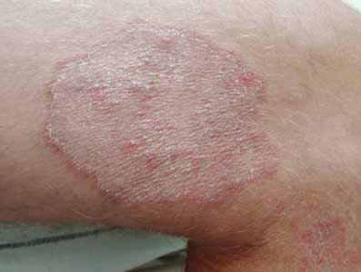 Ringworm (Deramatomycose, tinea)