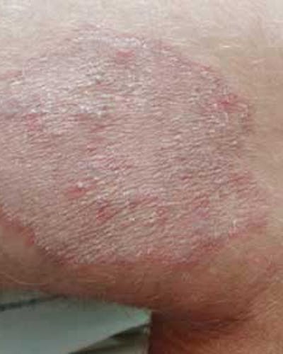 Tiña (Dermatomicosis, tinea)
