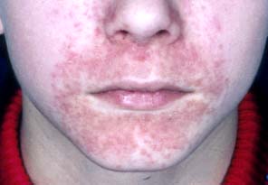Dermatitis perioralis