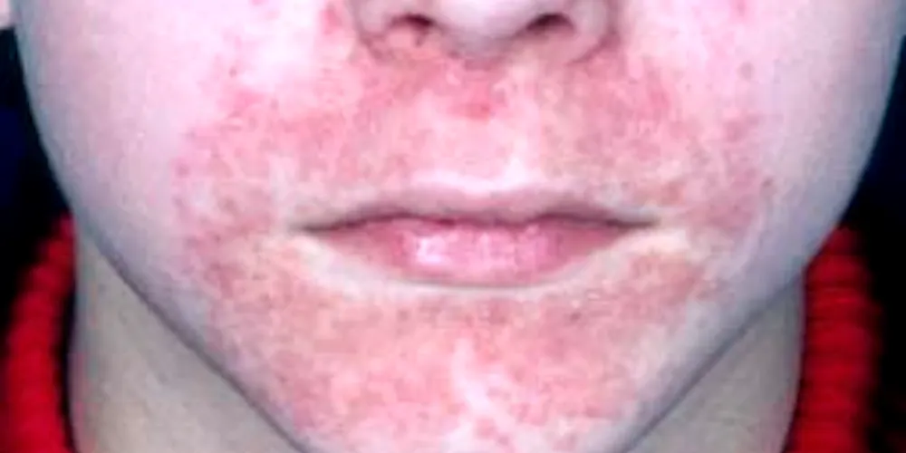 Dermatitis perioralis