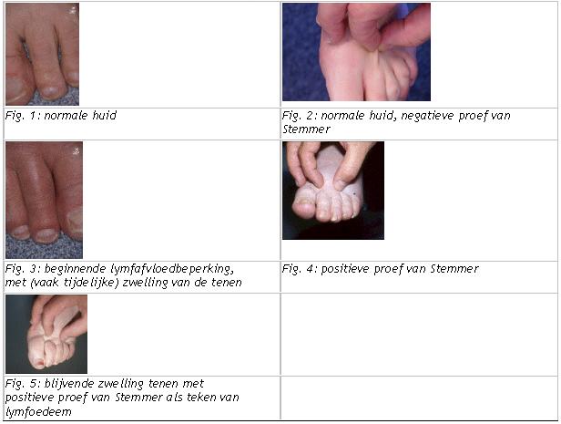 Lymfoedeem