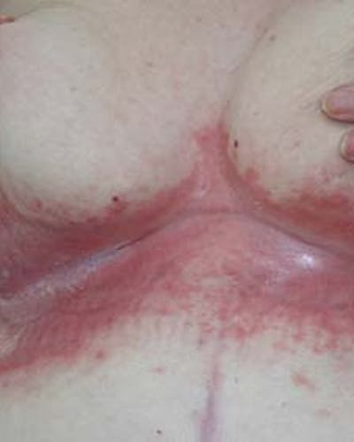 Intertrigo (erupción en pliegues cutáneos)