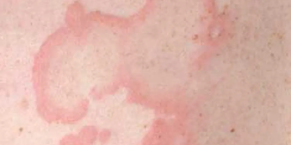 Urticaria