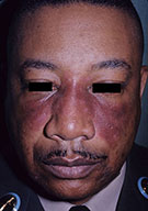 Jessner (ziekte van)