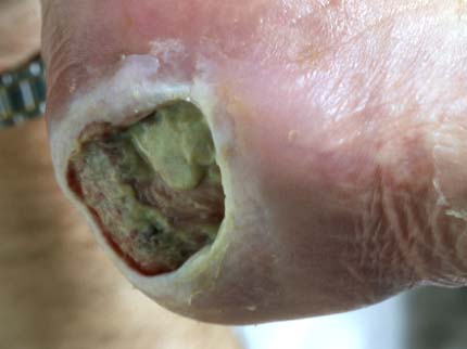 Decubitus (doorliggen)