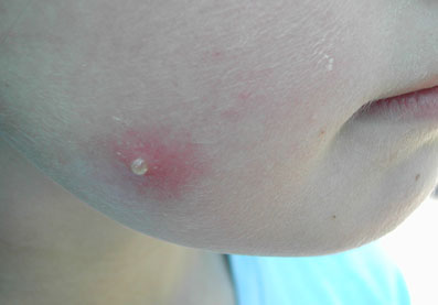 Insectenbeten (culicosis)