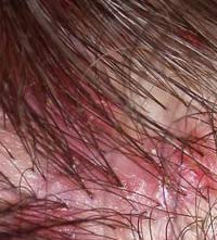 Folliculitis Decalvans