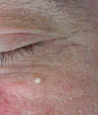 Milia (of gerstekorrel)