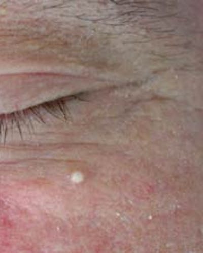 Milia (Granos de Mijo)