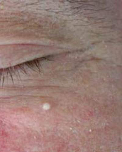 Milia (of gerstekorrel)