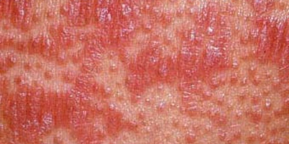 Prp Rash Everything About Pityriasis Rubra Pilaris: Symptoms, Causes, and Treatment.