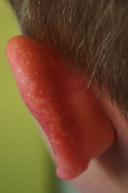 Juvenile Spring Eruption