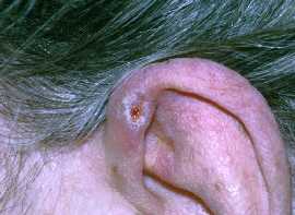 Chondrodermatitis Nodularis Helicis