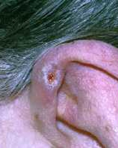 Chondrodermatitis Nodularis Helicis