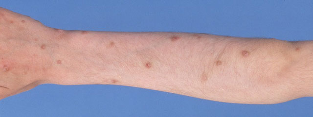 Prurigo nodularis