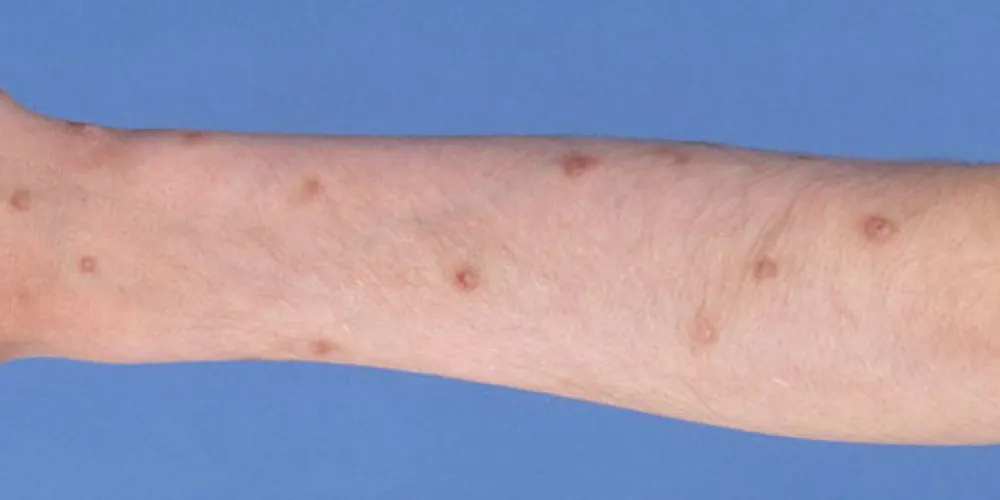 Prurigo nodularis