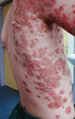 Impetigo