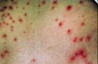 Folliculitis