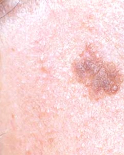 Verruca Seborroica